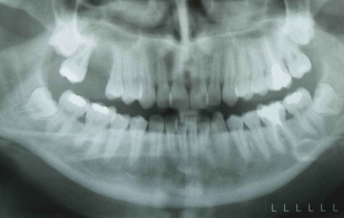 Impianti in zona estetica con rialzo verticale con griglia in titanio e rialzo del seno mascellare.