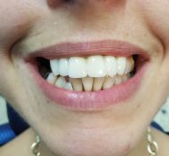 Cambiare aspetto si puÃ² iniziando dai denti