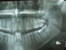 Estrazione dente del giudizio incluso