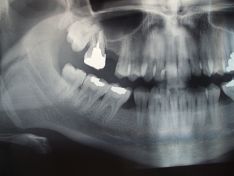 Estrazione complessa di un dente del giudizio