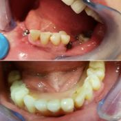 Overdenture in paziente con grave atrofia ossea