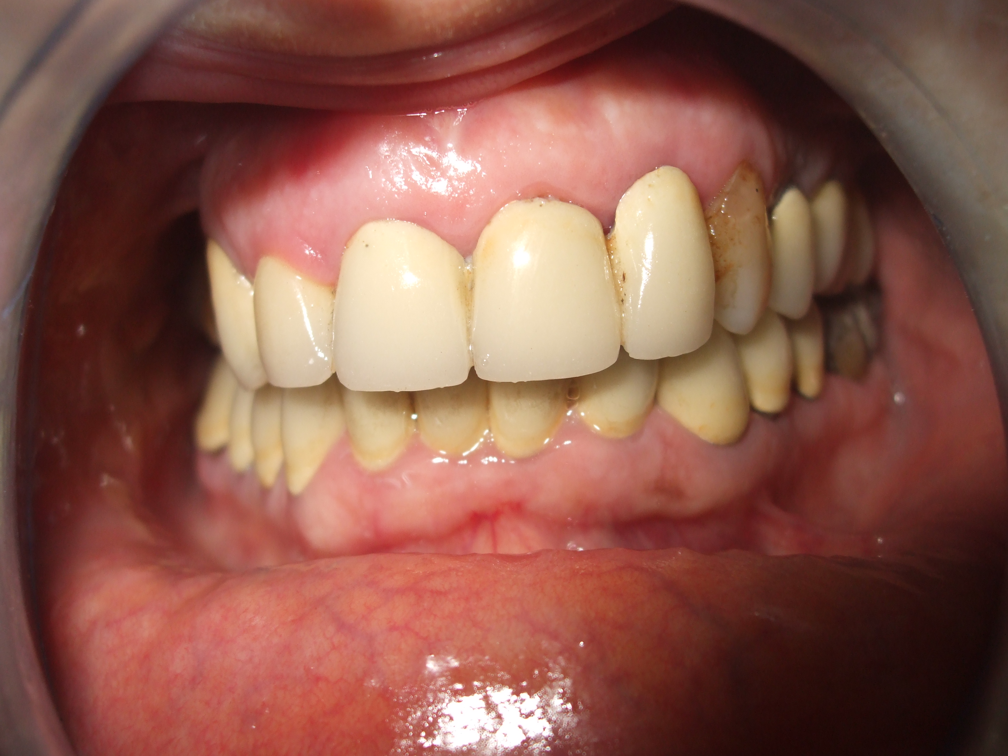 Recupero di elementi dentari
