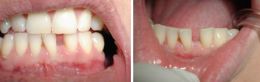 Chiusura di uno spazio tra I denti ( diastema ) in materiale estetico.