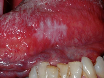 Possibili interazioni tra metalli e tessuti molli del cavo orale