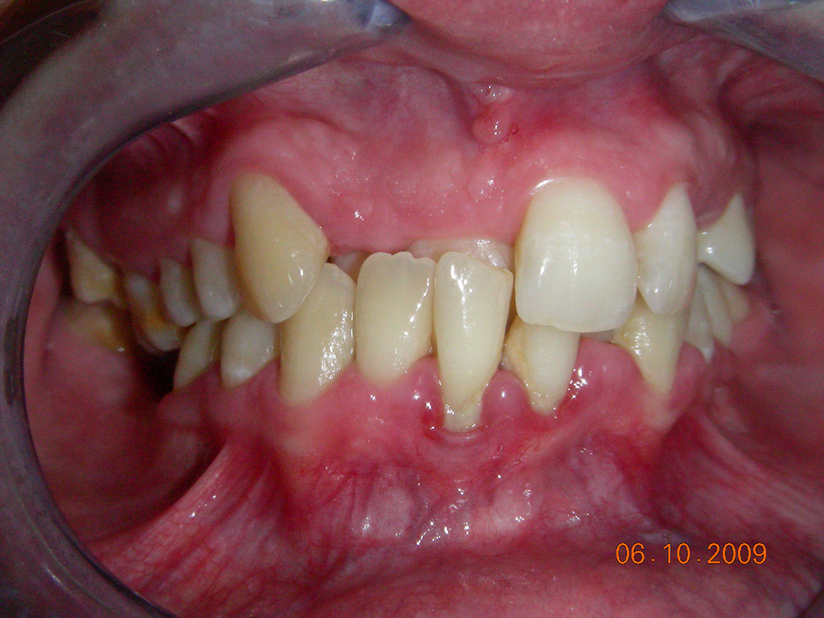 Affollamento dentario in paziente adulto