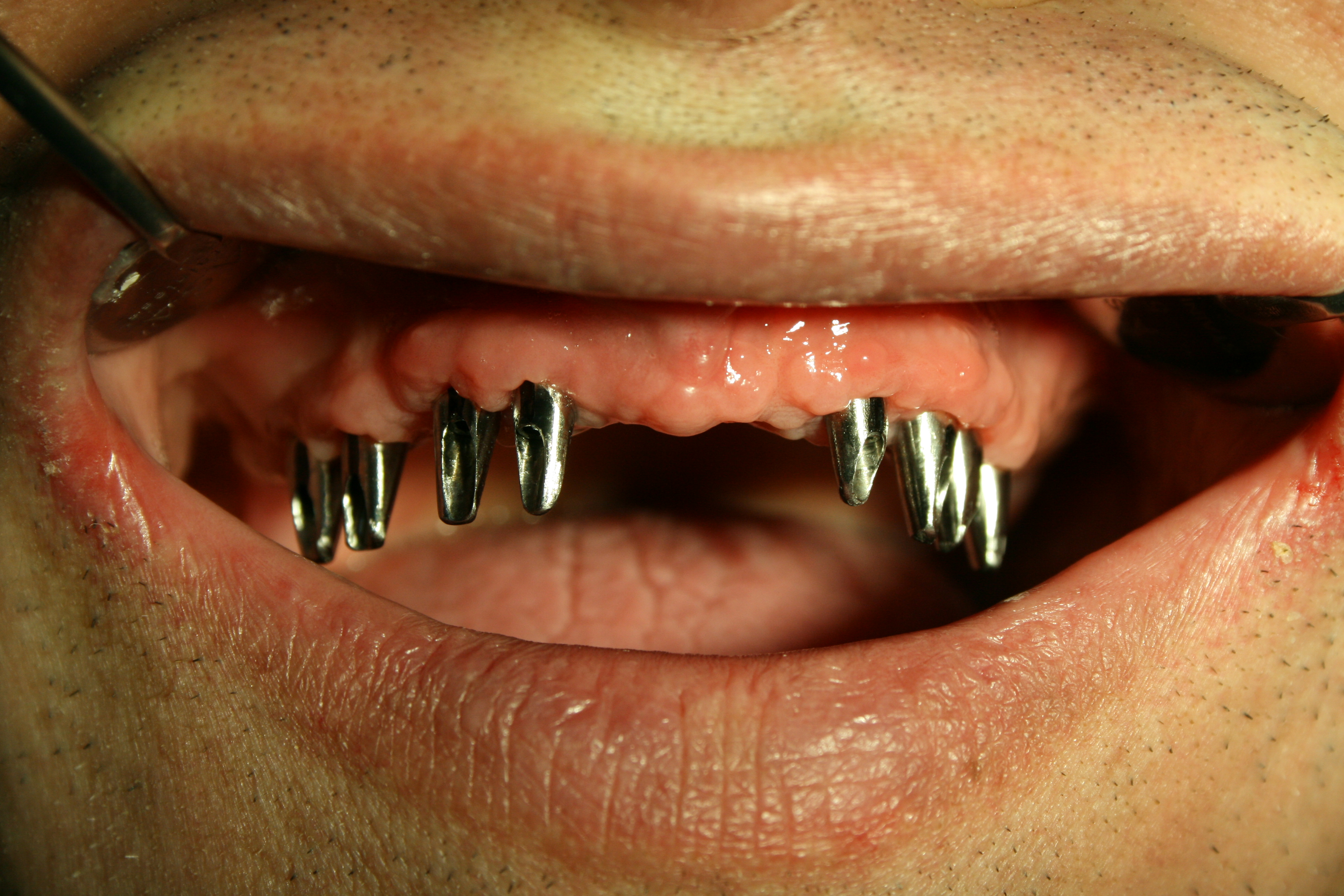 Riabilitazione arcata dentaria superiore