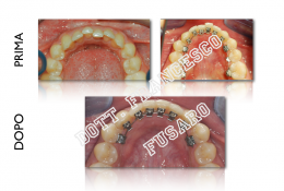 L'ortodonzia linguale e l'estetica in ortodonzia