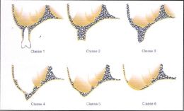 Riabilitazione Implanto-protesica in paziente con Atrofia del Mascellare superiore con ausilio di materiale eterologo e membrana