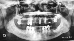 Riabilitazione Implantare in paziente Cardiopatico - Iperteso con atrofia del Mascellare superiore