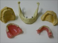 Overdenture su Minimpianti