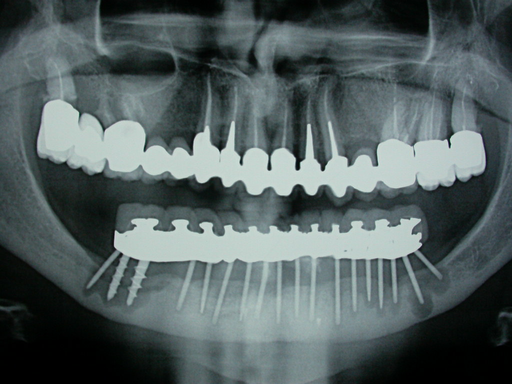 Effetti dell’Incidenza Implantare e loro Complicanze per la bonifica e riabilitazione protesica