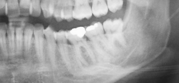 Risoluzione di un ascesso di origine endodontica