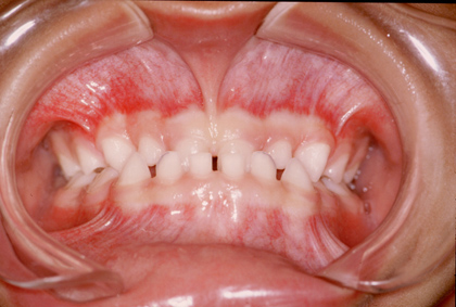 Ortodonzia in un bambino di 3 anni