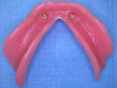 Overdenture