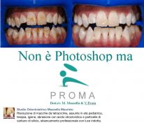 Sbiancamento denti in paziente con macchie da tetracicline