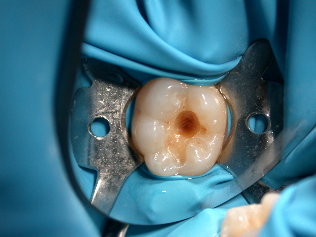 Ricostruzione molare inferiore