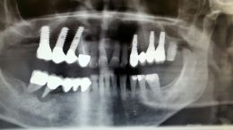 Implantologia post - estrattiva con rigenerazione ossea guidata