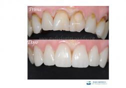 Faccette estetiche dentali