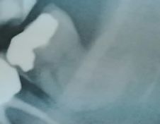 Devitalizzazione molare inferiore - Caso complesso con Radici molto Curve