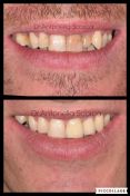 Corone estetiche in zirconia