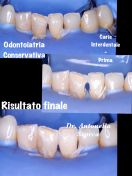 Terapia conservativa carie interdentale incisivi inferiori