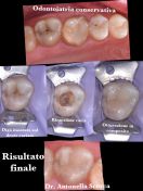 Terapia conservativa estetica carie molare superiore