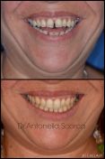Allineamento dei denti di un paziente con morso aperto