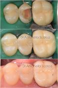 Salvare un dente devitalizzato con un intarsio in composito estetico