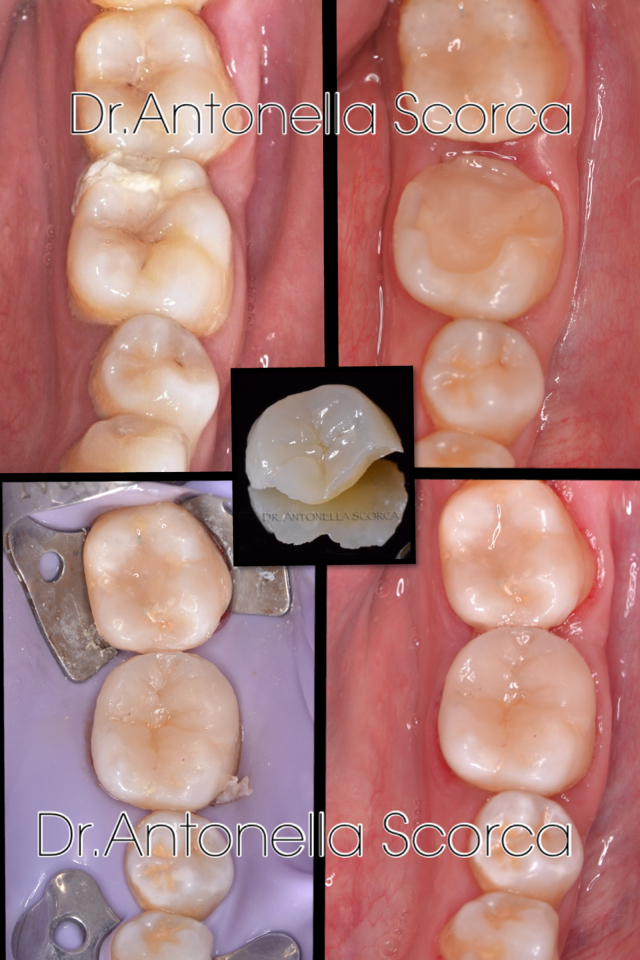 Intarsio in composito estetico per ricostruzione dente devitalizzato