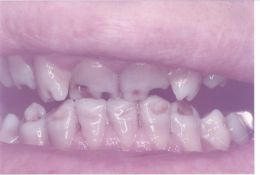 Ortodonzia immediata