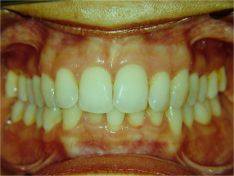 Damon il sistema ortodontico meraviglioso - il caso impossibile