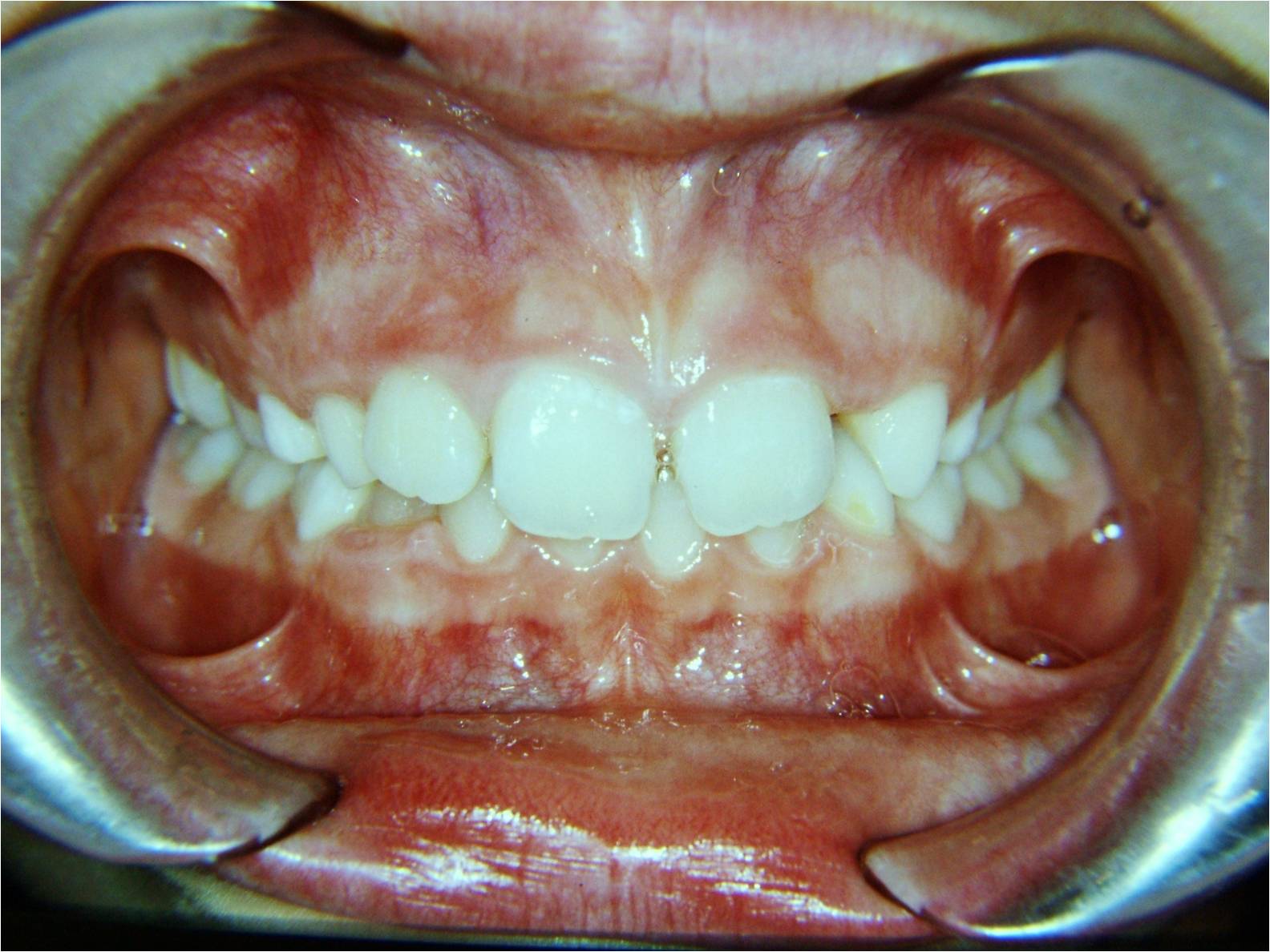 Damon  il  sistema  ortodontico  meraviglioso:  caso  4