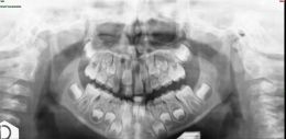 Estrazioni seriate in dentizione decidua tardiva