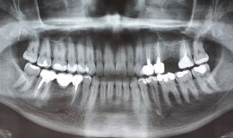 Impianto Tissue Level