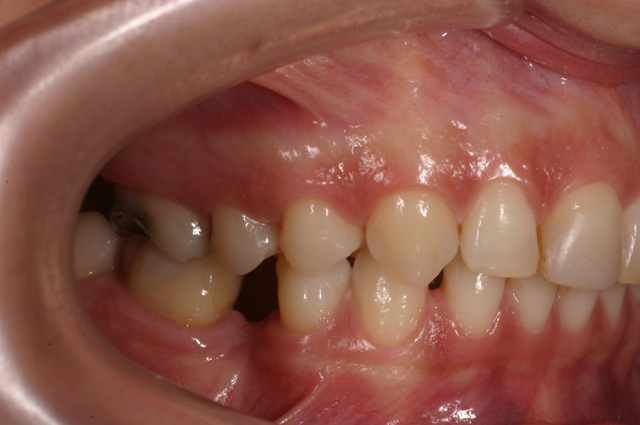 Recupero ortodontico per l'inserimento implantare