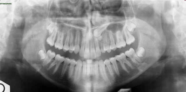 Rimozione di un odontoma composto in corso di trattamento ortodontico