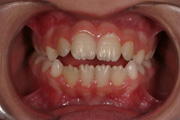 Terapia ortodontica intercettiva - grave morso aperto 