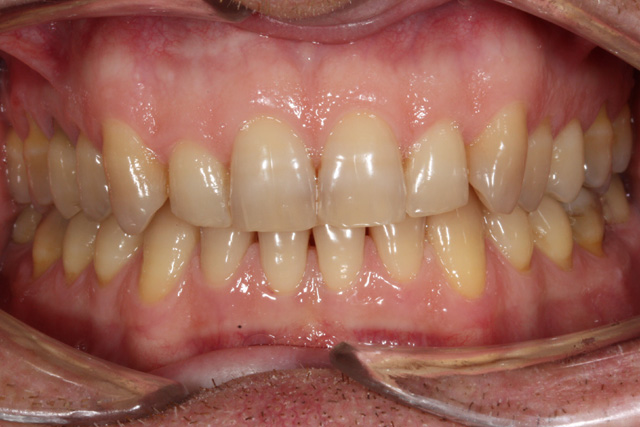 Sbiancamento dentale in paziente con grave discromia