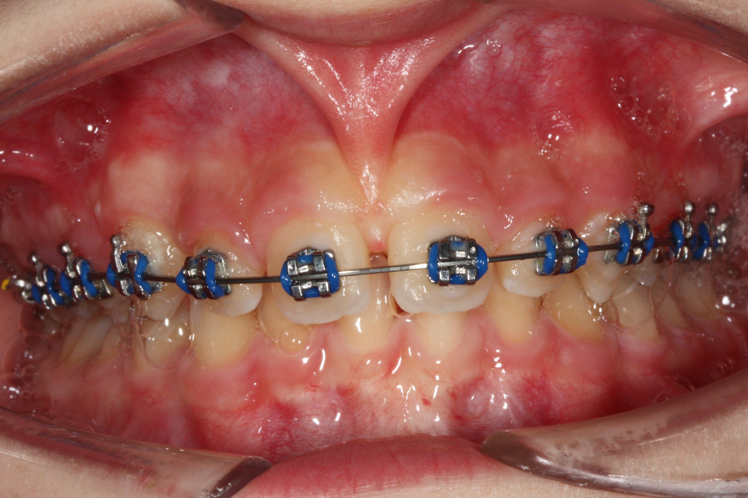 Frenulectomia Tecnica Doppia in Corso di Trattamento Ortodontico