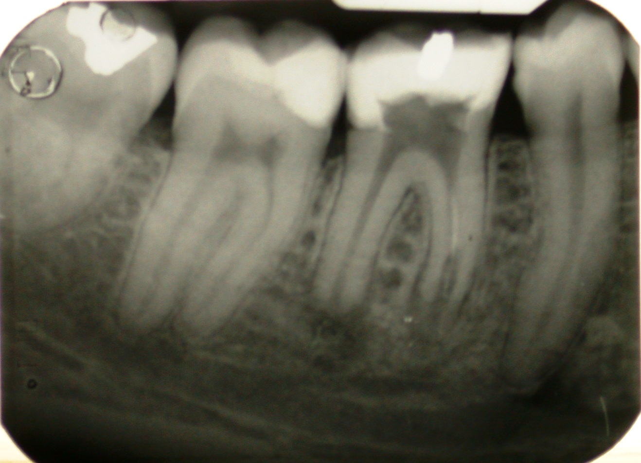 Ritrattamento endodontico di molare inferiore con lesione periapicale, rizolisi apicale e riassorbimento interno.