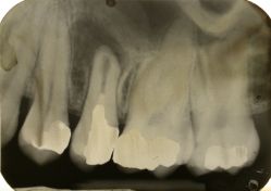 Ritrattamento endodontico con apecificazione di premolare superiore con granuloma, rizolisi apicale e riassorbimento interno.