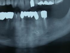 Asportazione chirurgica di odontoma composito in regione canina mandibolare.