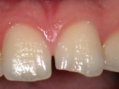 Ricostruzione del margine incisale di incisivo centrale superiore fratturato.