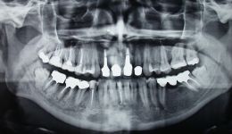 Autotrapianto simultaneo di 48 in 47 e di 38 in 46.