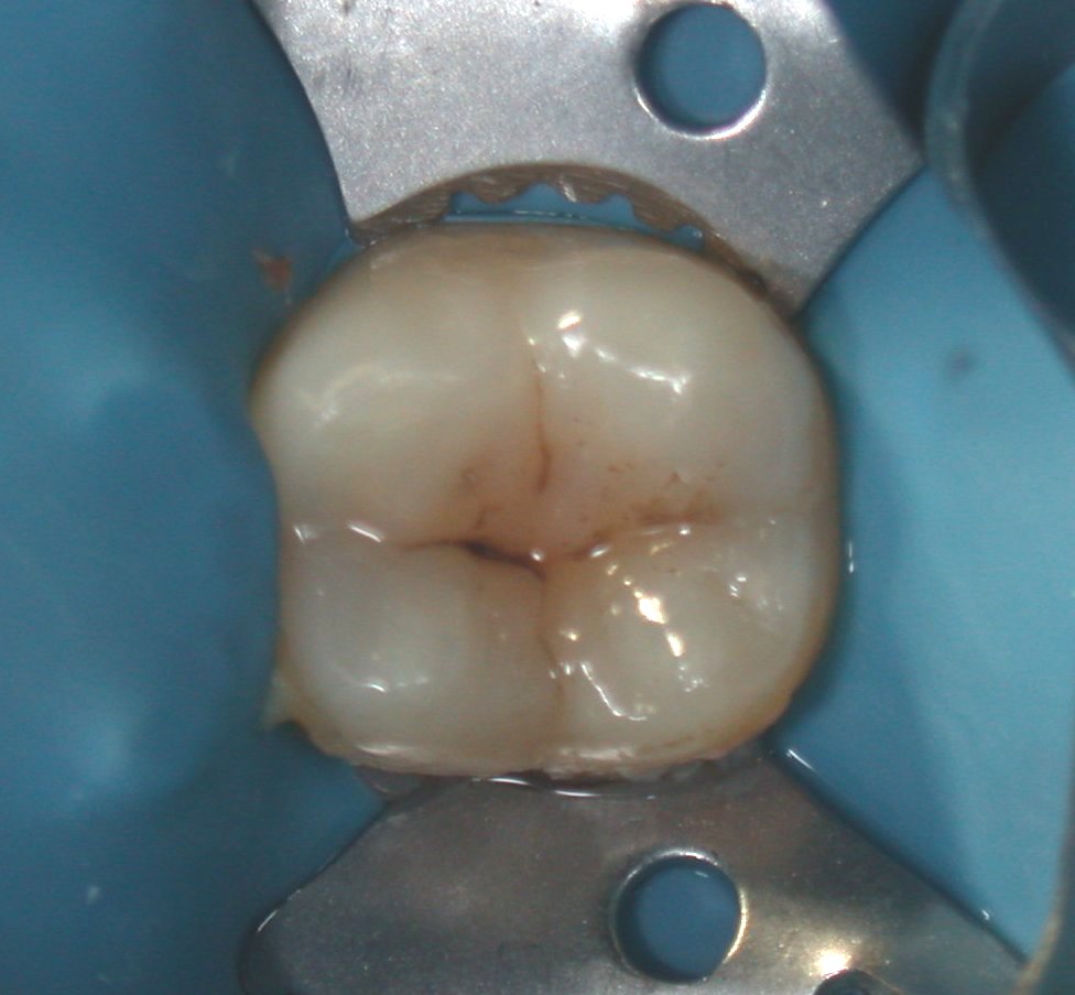 Otturazione occlusale di secondo molare inferiore.