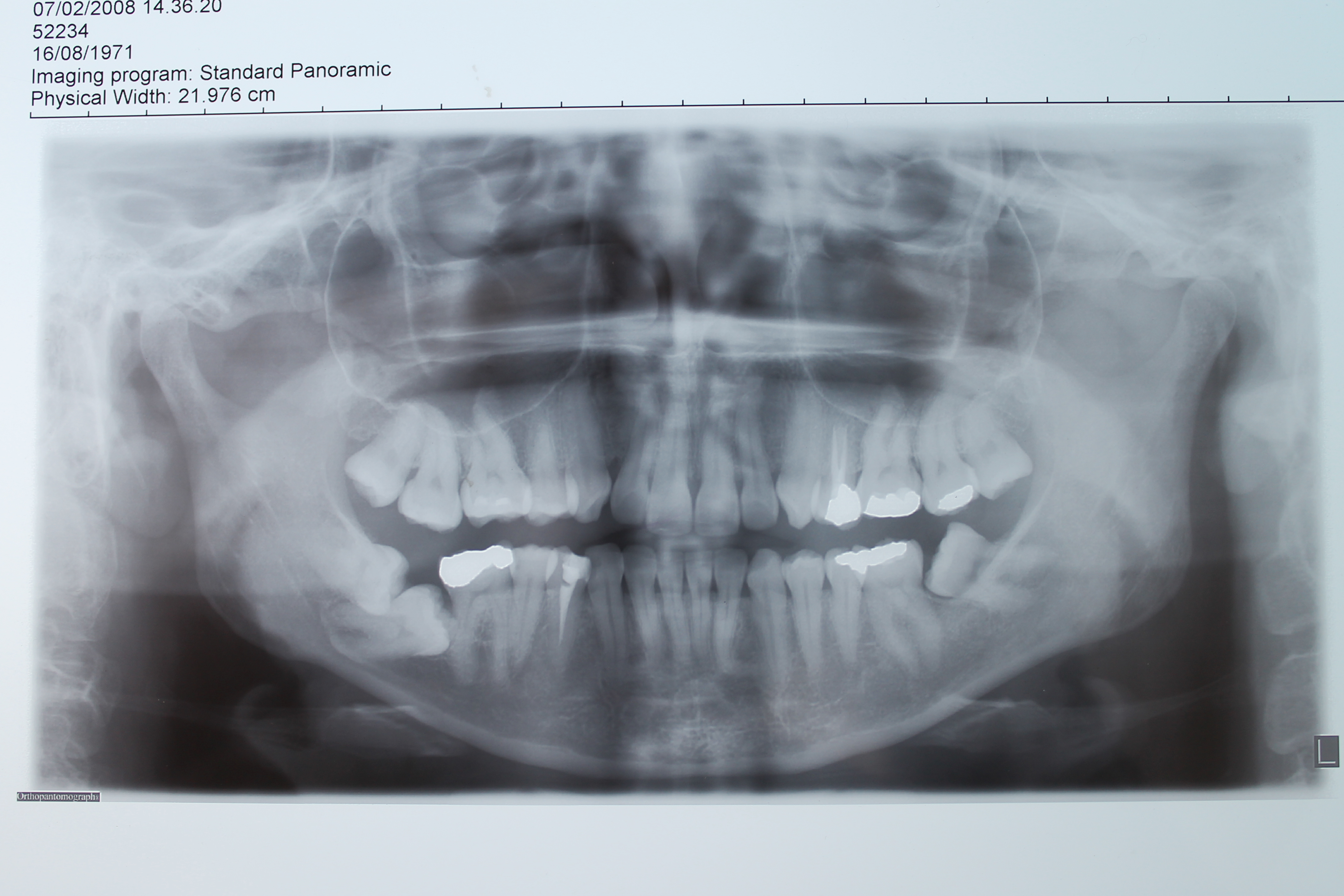 Estrazione di dente del giudizio e secondo molare entrambi inclusi.