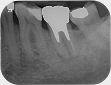 Ritrattamento endodontico complesso di molare inferiore con granuloma periapicale