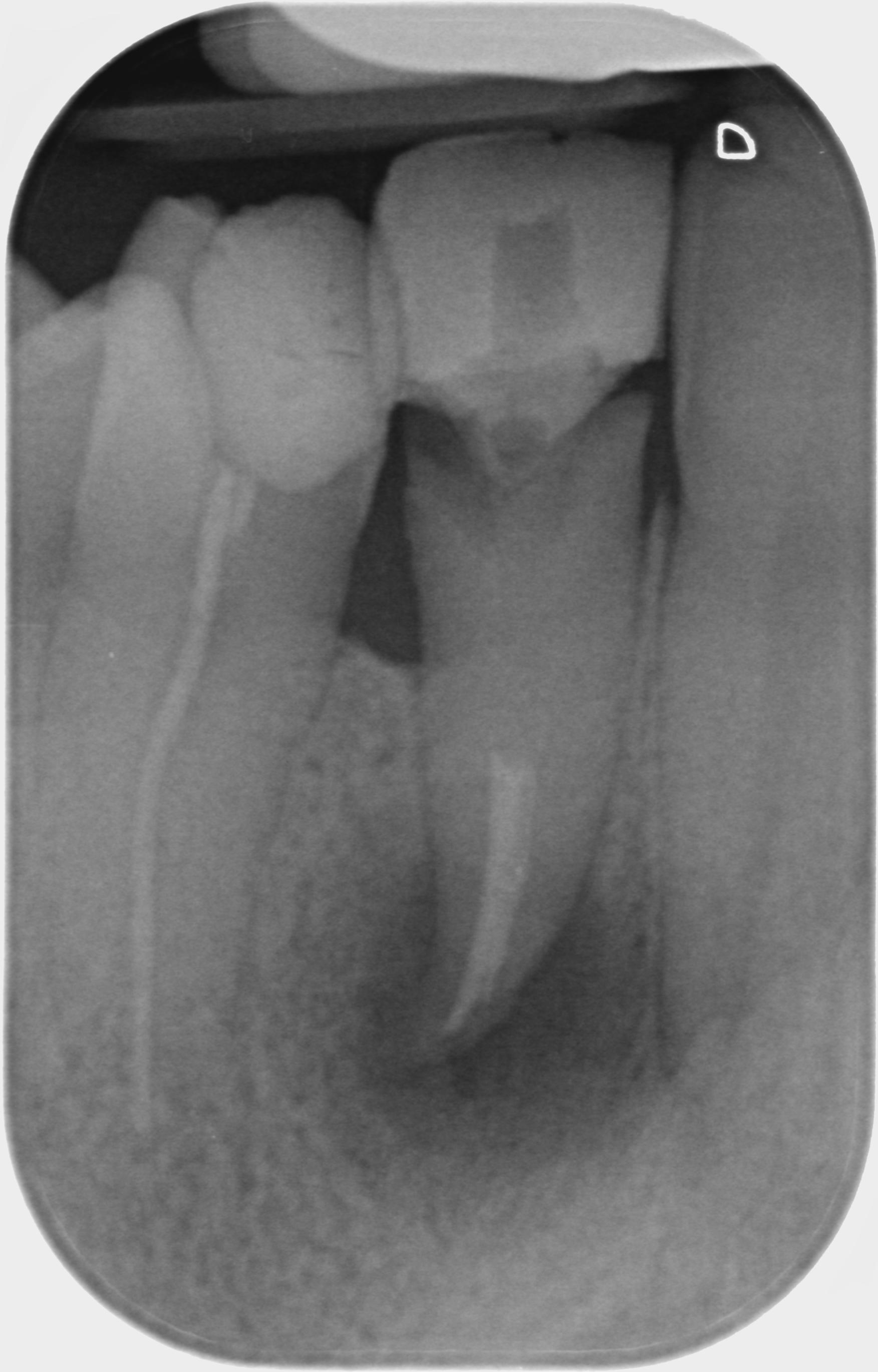 Granuloma in fase di guarigione dopo un ritrattamento endodontico