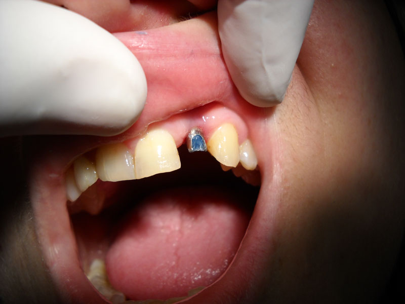 Implantologia: impianto dentale e corona