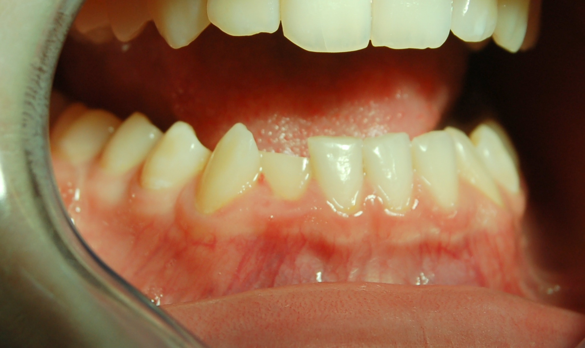 Trattamento conservativo fratture dentali